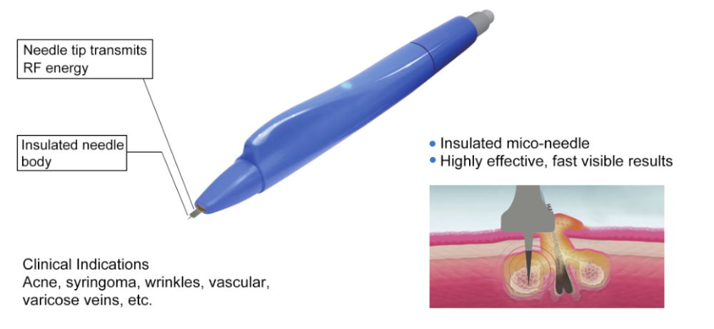 380V Laser Acne Treatment Devices Targeted Therapies For Facial Skin Cure Beauty