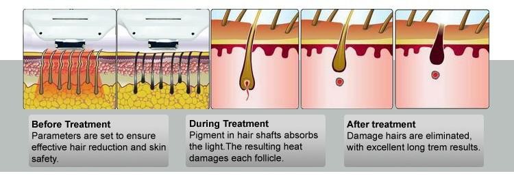 Elight IPL Hair Removal / electrolysis hair removal machine IPL laser