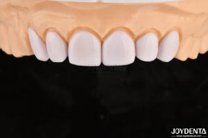 China Dental Veneers for Misaligned Teeth Biocompatibility And Gentle On Oral Tissues factory