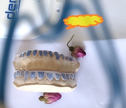 China Custom ISO13485 Bleaching Tray For Whitening Teeth factory