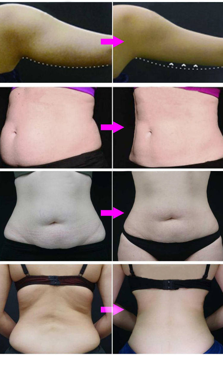 ISO90 1000W Cryolipolysis Slimming Machine Two Handle 6 Heads