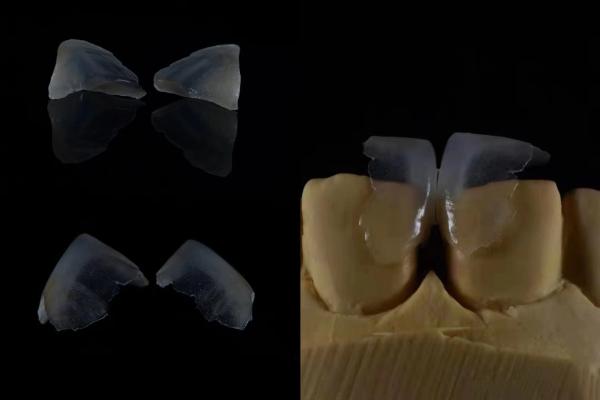 Comfortable Dental Veneers Strong Bond With Tooth Enamel For Secure Fit