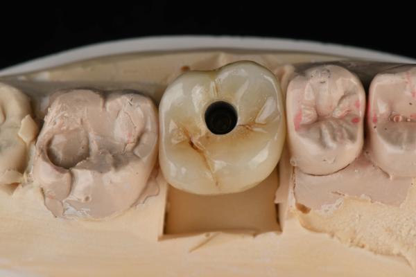 titanium 10mm Single Tooth Dental Implants Replacement Abutment Self Tapping