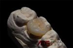 Precise Ceramic Dental Inlays And Onlays Restoration Stain Resistance