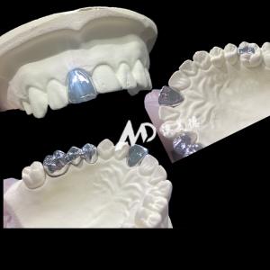 Metal Titanium Crown Precision Strength and Biocompatibility for Lasting