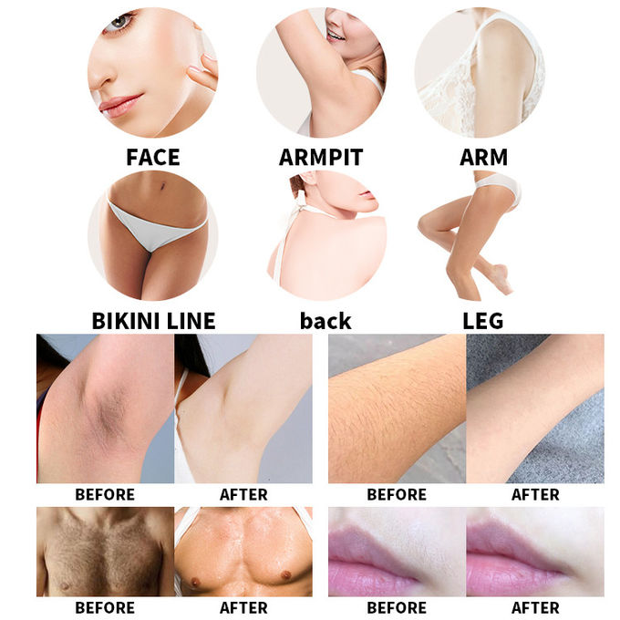 Cutting-Edge Diode Laser Hair Removal Machine for Flawless Skin 1