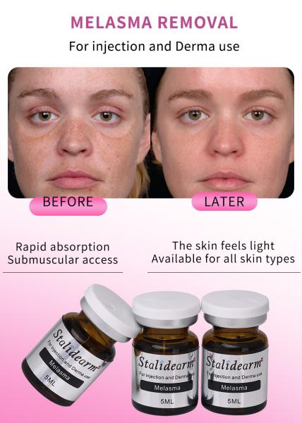 Stalidearm Dermal Fillers Improve The Look Of Freckle Facial Skin Care Melasma