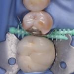 Composite Dental Sectional Matrix System Plastic Adaptive Wedges W3 1.0