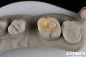 China Strong Resistance To Fracture Emax Inlay Onlay Natural-looking Esthetics And Durability factory