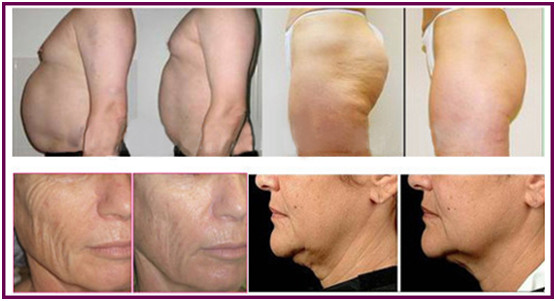 Safety Body Contouring RF Skin Tightening Machine Equipment Cellulite Reduction