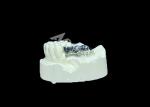 Long-lasting Full Cast Titanium Crown Dental Implant Molar For Missing Teeth