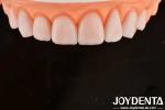 Custom Made IPS Porcelain Emax Veneers Dental Restorations Chipping Resistant