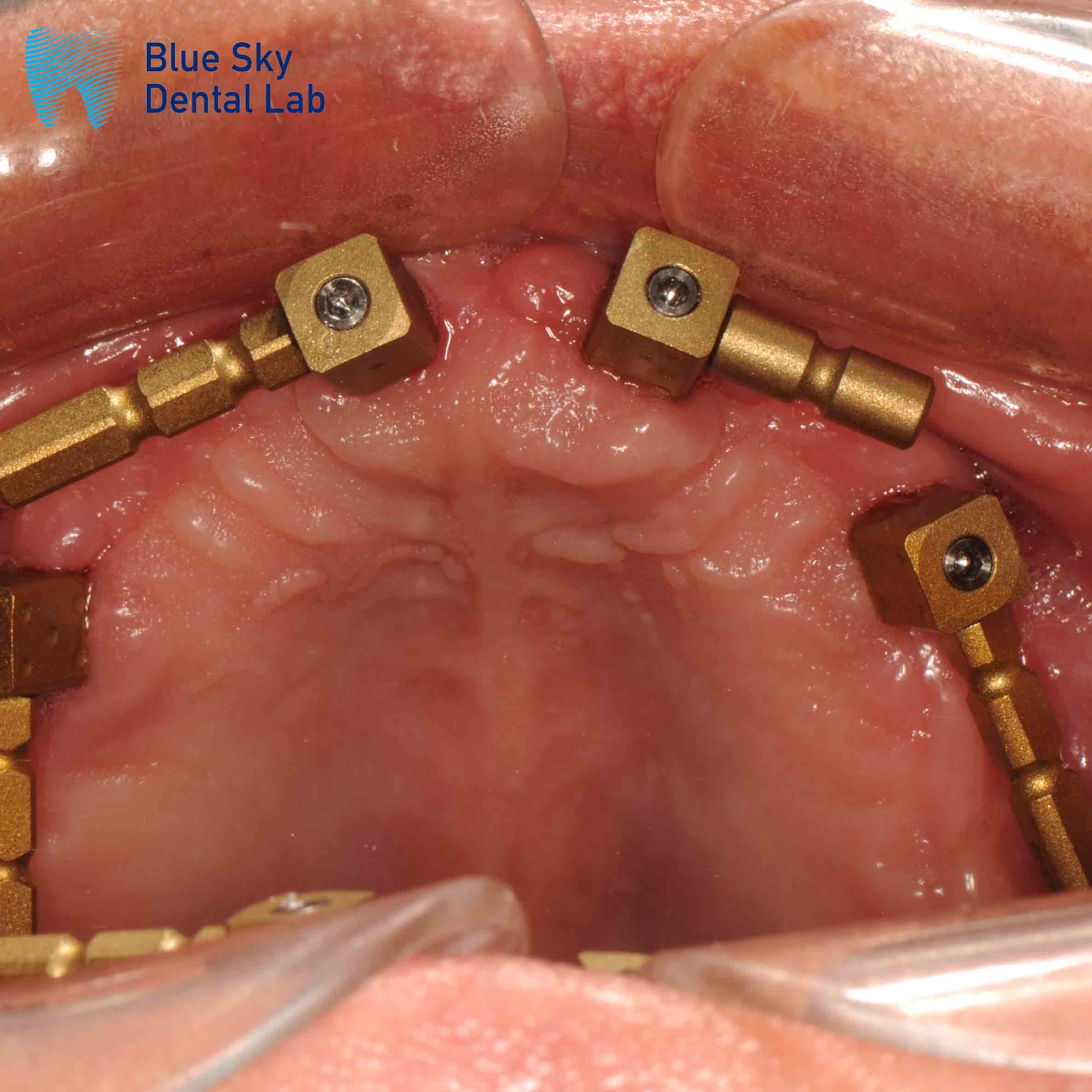 Gold A Set Multi Unit Scan Body For Edentulous Blue Sky Implant
