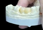 Durable Wear Resistant Customized All Ceramic Crowns and Bridges for Perfect Fit