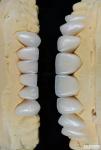 Glossy Surface Texture Feldspathic Veneer Natural Looking Porcelain Veneer