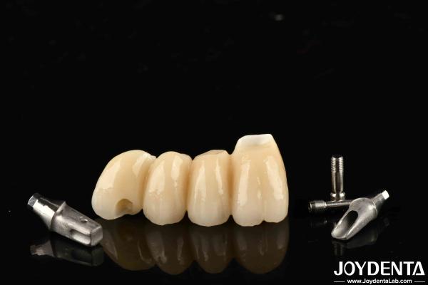 Customizable Implant Crown And Bridge In Porcelain Precision For Perfect