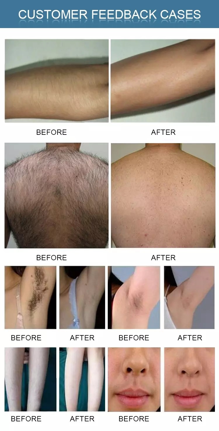Best-selling 755nm 808nm 1064nm diode laser hair removal Laser machine for sale LF-646