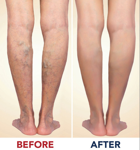 Saphenous Veins Removal Surgical Laser Equipment