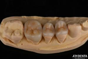 China Natural Looking Emax Inlay Onlay Long Lasting Dental Restoration 0.5mm 1mm 1.5mm Thick factory