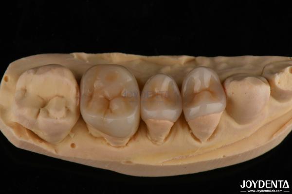 Natural Looking Emax Inlay Onlay Long Lasting Dental Restoration 0.5mm 1mm 1.5mm