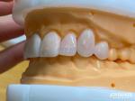 High Permeability Natural Looking Veneers Porcelain Veneers Emax Customized