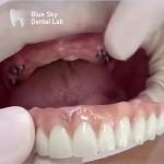 Nature Design Dental Implant Case Implant Operation Cases For Multiple Choices