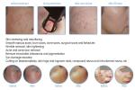 Multifunction medical laser co2 fractional/fractional co2 laser/co2 fractional
