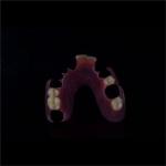 Comfortable Partial Valplast Flexible Dentures Nylon Material