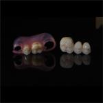 Anti Wear Implant PFM Dental Bridge Prosthesis Teeth Replacement