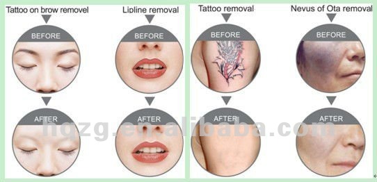 Q Switch ND YAG Laser Machine For Tattoo Removal / Skin Rejuvenation