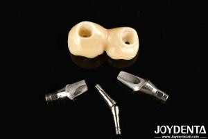 China Experience Aesthetically Pleasing Results With Customizable Implant Retained Crown And Bridge factory
