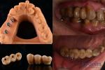 Ivoclar Implant Ball Attachments Removable Dental Implant Material For Oral