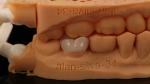 Translucency Dental Zirconia Crown Inlay Onlay Crown For Restore Natural Cavity