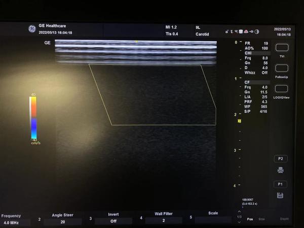 GE VividE Original Linear Ultrasound Probe 9L-RS , GE Ultrasound Transducers 3.3
