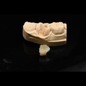 China Metal Free Composite Crowns Inlays And Onlays Bridges Implants ODM factory