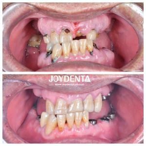 China Resistant To Wear And Deformation Zirconia Dental Crowns Durable and Suitable For Posterior And Anterior Restorations factory