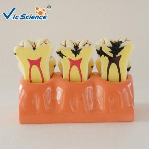 China Decayed Tooth Orthodontic Study Models 4 Times Caries Disassembling Model factory