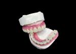 Zirconia Dental Implant Crown Bridge All On 6 For Missing Teeth Replacement