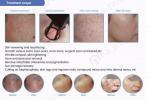 RF Fractional co2 laser acne scars removal and vaginal tightening machine