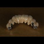 Aesthetic Partial Denture Precision Attachments Medical Grade OEM