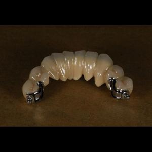 China Aesthetic Partial Denture Precision Attachments Medical Grade OEM factory