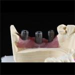 Cad Cam Implant PFM Crown Bridge Dental Medical Grade Adhesive