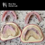 Full Upper And Lower Titanium Bar Blue Sky Dental Implants