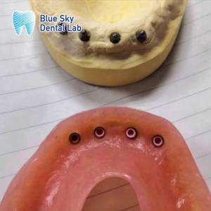 China Removable Implant Restoration Locator Implant Denture Full Mouth Restoration factory