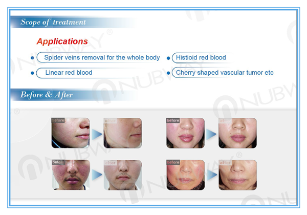 Painless safety high frequency 30MHZ spider vein removal and varicose vein treatment