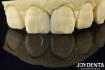 Customizable Smooth Micro Thin Veneers Long Lasting Natural Looking Veneers