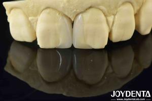 China Customizable Smooth Micro Thin Veneers Long Lasting Natural Looking Veneers factory