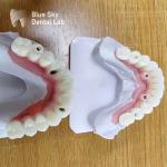 Dental Multi Implant Cases Customized Implant Procedure Cases