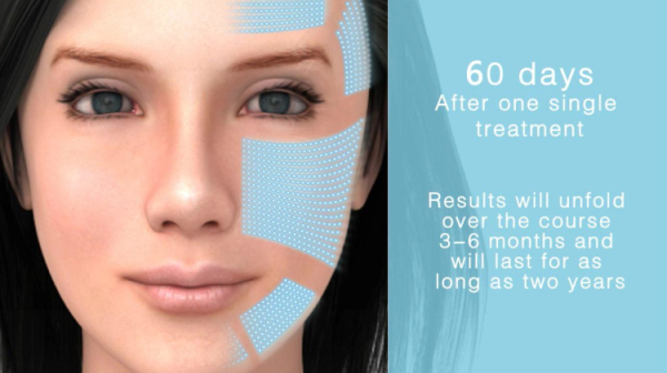 2016 Amazing USA High Intensity Focused Ultrasound face lifting hifu/hifu face lifting