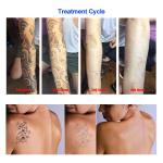 Tattoo Pigment Removal Black Doll Laser Treatment Machine Perfectlaser